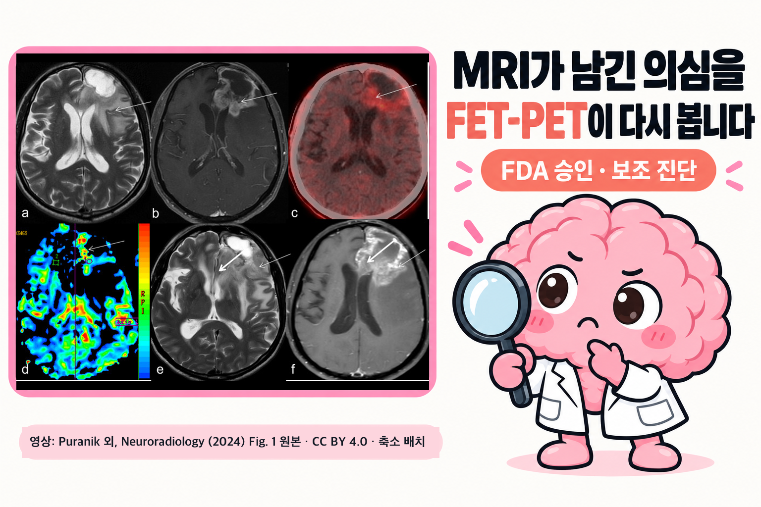 Puranik 외 논문 Figure 1의 치료 뒤 교종 MRI·FET PET 원본 영상 여섯 장(a~f) 옆에서 Brain 박사가 돋보기를 들고 살피며, ‘MRI가 남긴 의심을 FET-PET이 다시 봅니다’와 ‘FDA 승인 · 보조 진단’ 문구가 적힌 표지