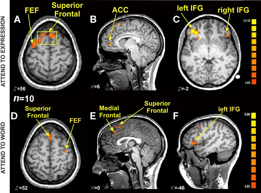 감정 스트룹 과제 fMRI 결과 그림. 뇌 단면 여섯 장에 상전두·전대상피질·하전두이랑 등의 활성 부위가 주황색으로 표시돼 있습니다